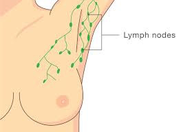 What Is Axillary Lymph Node Dissection ?