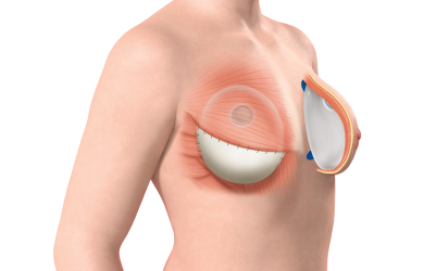 Breast Implant vs Flap Reconstruction After Mastectomy