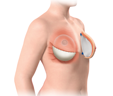 Breast Implant vs Flap Reconstruction After Mastectomy