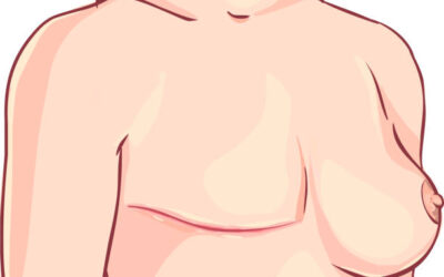 Unilateral vs Bilateral Mastectomy: When Are Both Breasts Removed