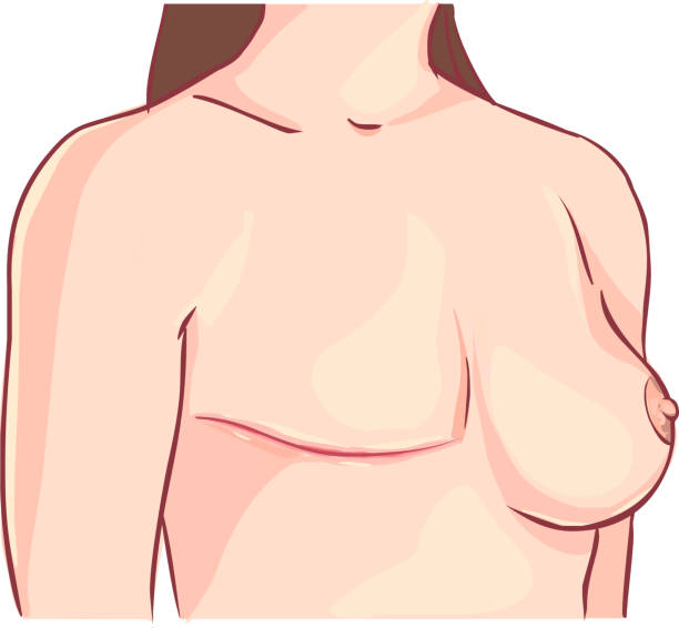 Unilateral vs Bilateral Mastectomy: When Are Both Breasts Removed