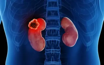 Can Kidney Cancer Be Treated Without Full Removal?