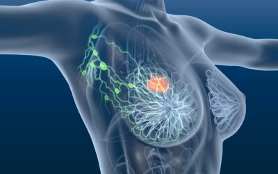 When Should Indian Women Start Breast Cancer Screening ?
