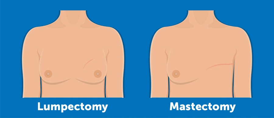 Comparison of breast surgery options: left image shows a lumpectomy scar on the chest, right image shows a mastectomy scar across the chest.