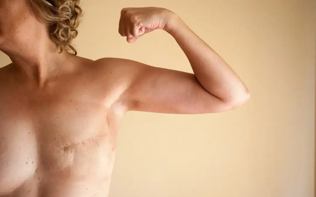 What Is a Mastectomy and Who Needs It