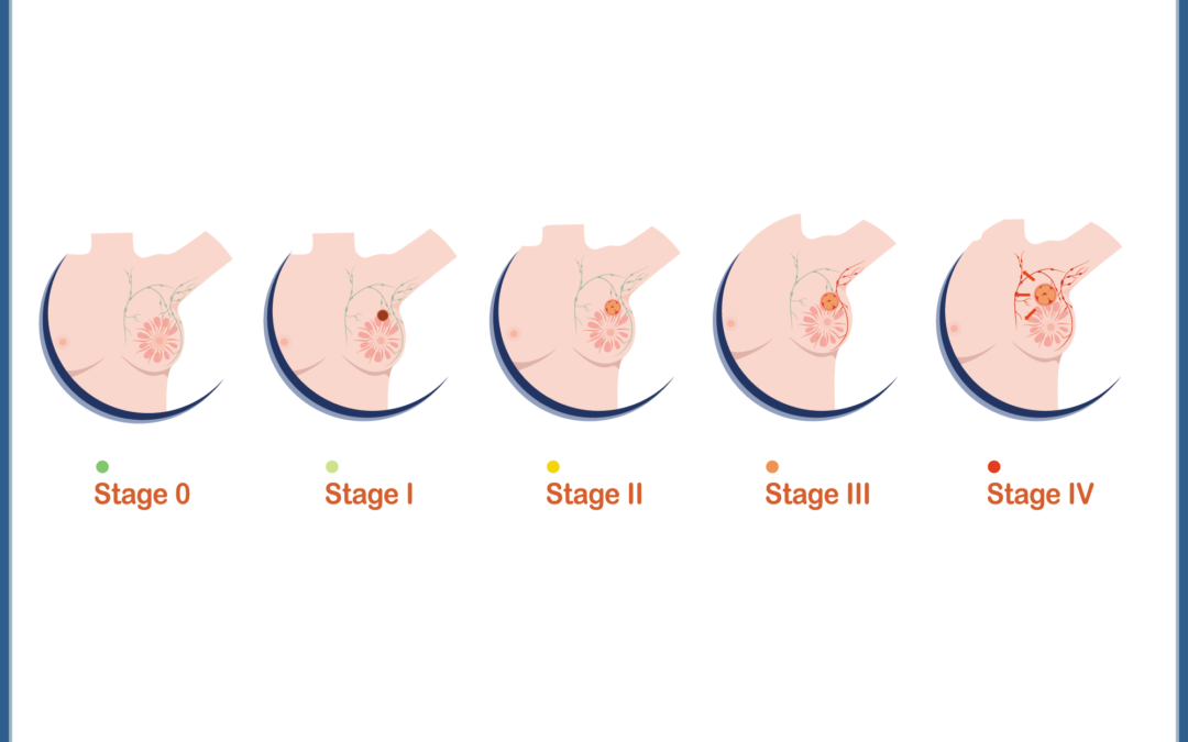 Stage 2 and Stage 3 breast cancer require different surgical approaches. Here is what changes between them and why the stage shapes the operation.