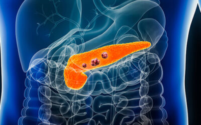 How Is Pancreatic Cancer Diagnosed Early