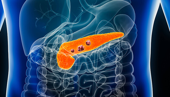 How Is Pancreatic Cancer Diagnosed Early