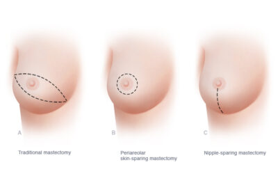 What Is Partial Mastectomy vs Total Mastectomy ?