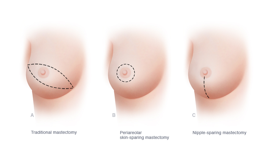 What Is Partial Mastectomy vs Total Mastectomy