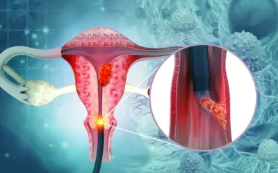 Can the HPV Vaccine Prevent Cervical Cancer?