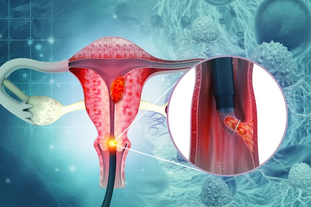 Can the HPV Vaccine Prevent Cervical Cancer?