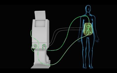 Understanding HIPEC Treatment Costs in Bangalore