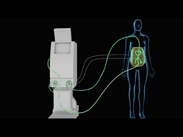 Understanding HIPEC Treatment Costs in Bangalore