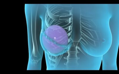 What Is Breast Reconstruction Surgery After Mastectomy ?