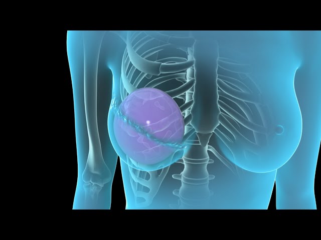 What Is Breast Reconstruction Surgery After Mastectomy