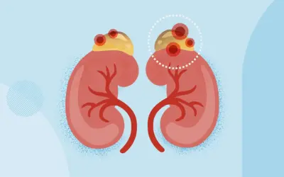 What Causes Adrenal Tumours to Turn Cancerous?