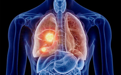 Lung Cancer in Non-Smokers: Causes and Treatment