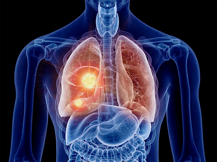 Lung Cancer in Non-Smokers: Causes and Treatment