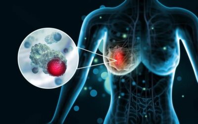 Breast Pain: Cancer or Hormones?