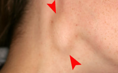 Can a Movable Lump Under Skin Be Cancer?