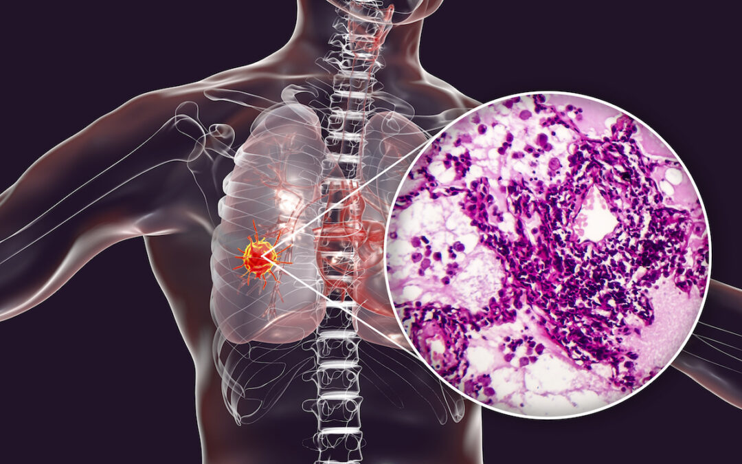 Medical illustration of a torso with a highlighted left-breast tumor and a magnified inset of cancer cells under a microscope.