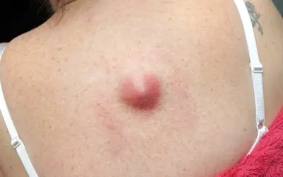 Is a Painless Lump Always Cancer