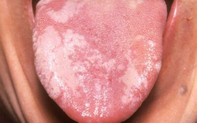 Is a White Tongue Patch Always Cancer?