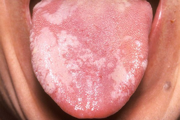 Is a white tongue patch always cancer - Dr. Sandeep Nayak