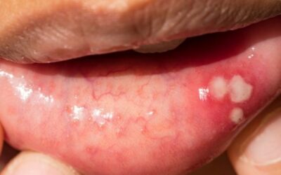 Mouth Ulcer for 3 Weeks: Can It Be Cancer?
