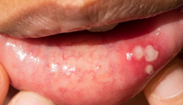 Mouth ulcer for 3 weeks can it be cancer- Dr. Sandeep Nayak