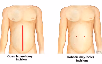 Open vs Laparoscopic vs Robotic Cancer Surgery — Which Is Better?