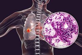 What Does a Suspicious Biopsy Mean?