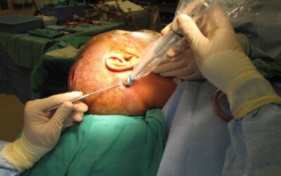 What Is Sentinel Lymph Node Biopsy?