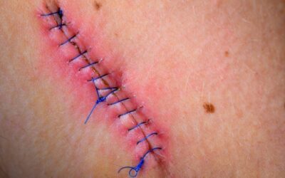 When to Worry About Your Surgical Wound?