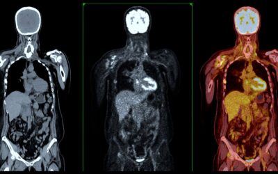 Why Does a Doctor Want a PET Scan After a CT Scan?
