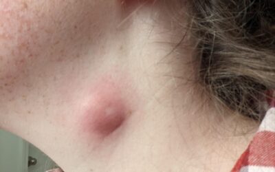 Why Won’t My Neck Lump Go After Antibiotics?