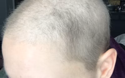 Will My Hair Grow Back the Same After Chemo?