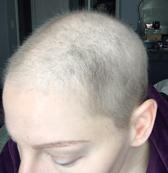 Will my hair grow back the same after chemo