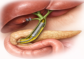 Bile Duct Surgery vs Stenting: Which Is Better?