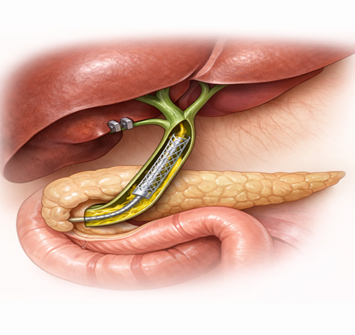 Bile Duct Surgery vs Stenting - Dr. Sandeep Nayak