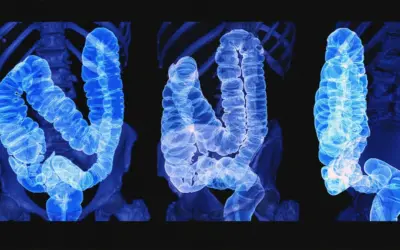 Can Colon Cancer Be Caught Before Stage 3?