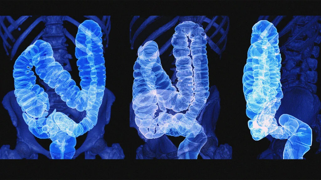 Catching Colon Cancer Before Stage 3 - Dr. Sandeep Nayak