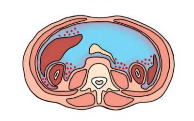 Can HIPEC Treat Stage 4 Ovarian Cancer?
