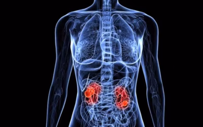 Can Kidney Cancer Spread to Both Kidneys?