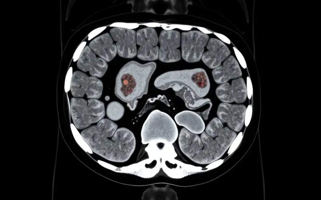 Colonoscopy vs CT Colonography - Dr. Sandeep Nayak