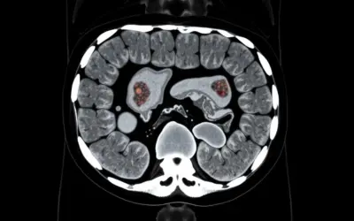 Colonoscopy vs CT Colonography: Which Is Better?