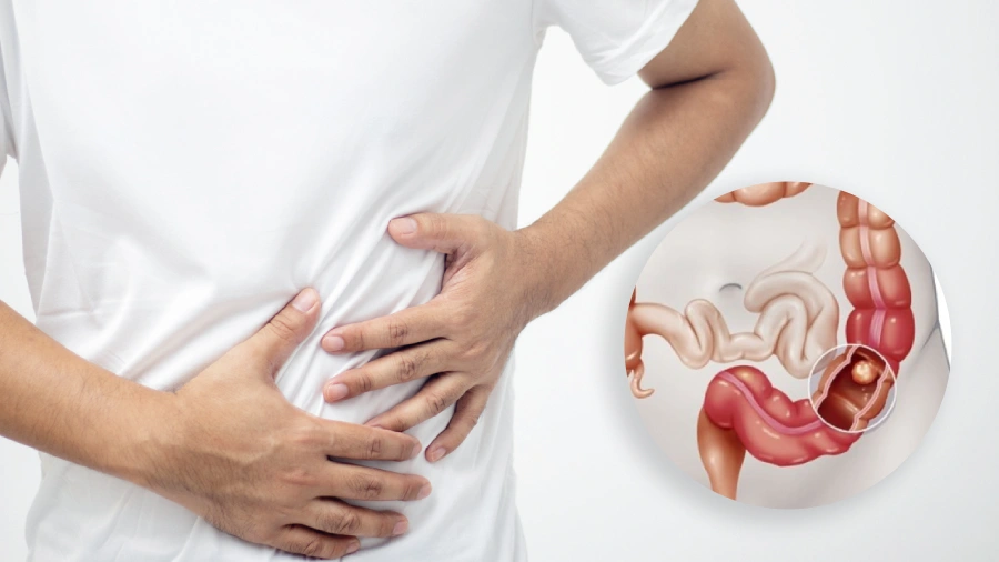 Cost of Rectal Cancer Surgery in Bangalore - Dr. Sandeep Nayak