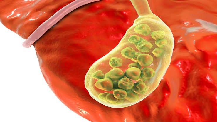 Early Detection of Bile Duct Cancer - Dr. Sandeep Nayak