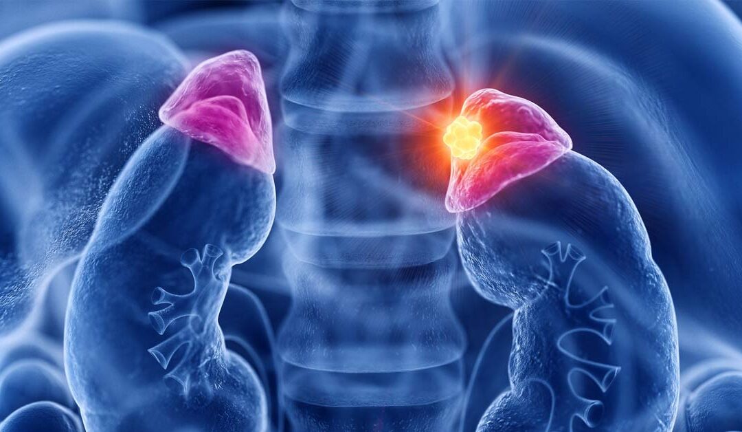 Adrenal Cancer vs Tumour - Dr. Sandeep Nayak